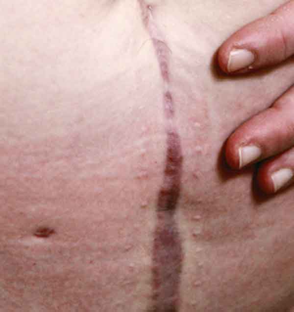 Belly Scar From Surgery Staples Removed
